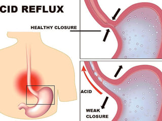 30% of UAE population suffers from acid reflux