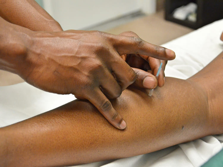 Accupuncture