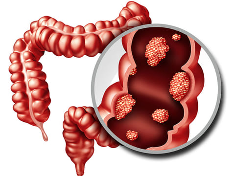 Everyone should get a colonoscopy as they hit 50