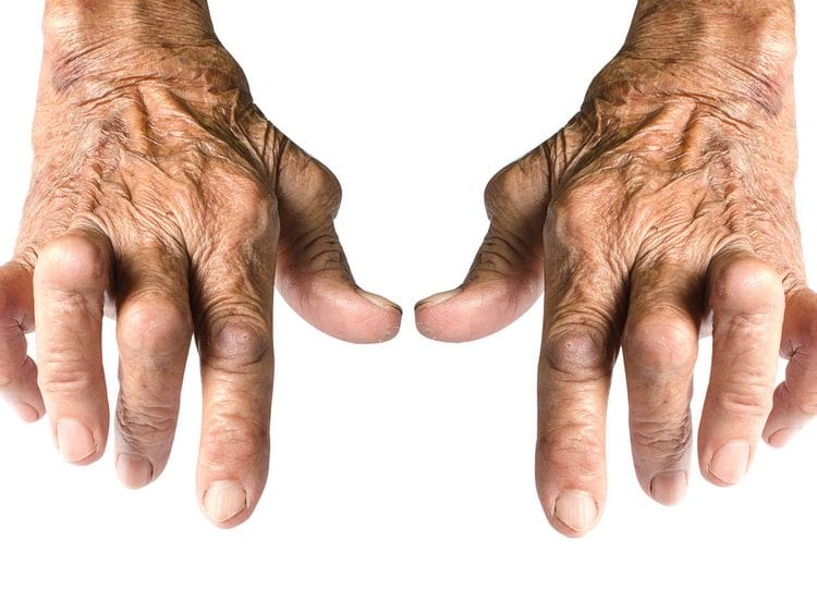 Arthritis123