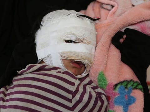  A child of a Daesh fighter, with burn injuries covering his head, is seen at a hospital in Hasaka, northeastern Syria 