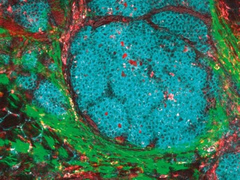 An image of a breast cancer tumour and its microenvironment. Tumour cells are in cyan, macrophages in red and collagen fibres in green.