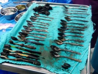 Egypt: Forks, spoons and toothbrushes found in man’s stomach