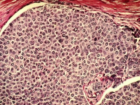 A study published in Nature reveals that consuming fructose can speed up tumour growth by setting off an indirect interaction between the liver and cancer cells — a phenomenon known as "metabolic cross-talk". Image for illustrative purposes only.