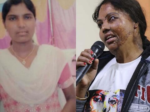 Treatment for acid attack victims like Bala is a prolonged one and they go through several surgeries, each more painful than the other.