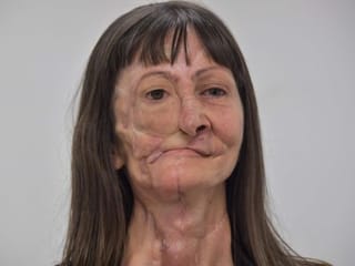Low-cost prosthesis gives Brazil cancer survivor a new face