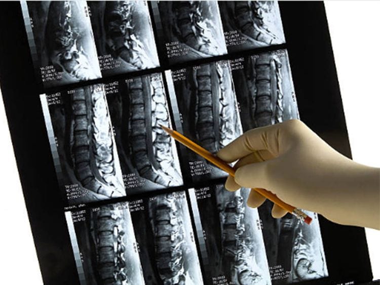 Is your lifestyle affecting your bone health?