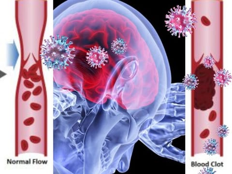 BLOOD CLOTTING ABNORMALITIES: Four separate clinical studies conducted on hundreds of patients show a significant link between blood coagulation (also known as clotting), elevated levels of D-Dimer (protein fragments in the blood) among COVID-19 patients, higher severity and eventual death.   