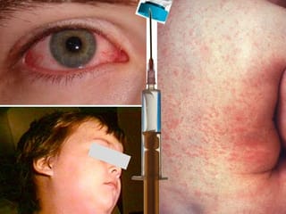 List: Diseases prevented by vaccines