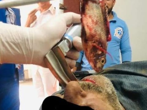 An Egyptian medical team managed to extract a live fish from a fisherman’s windpipe.
