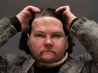 Photos: Lucky to be alive, owner of new face, hands learns to feel life anew