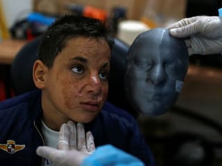 Photos: Gaza burn victims get 3D-printer face masks made close to home