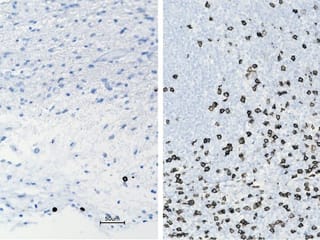 Unusual treatment shows promise for kids with brain tumours