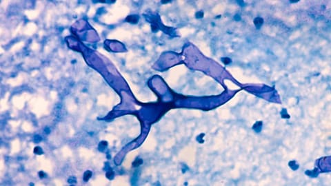 Mucormycosis is caused by a family of molds called mucormycete (black fungus), which grow in soil and decaying organic matter, such as rotting leaves and wood, according to the US Centres for Disease Control and Prevention.