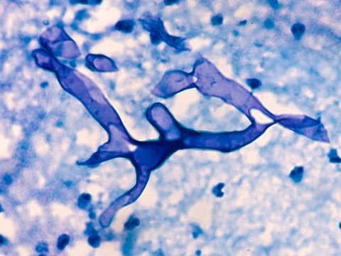 Mucormycosis is caused by a family of molds called mucormycete (black fungus), which grow in soil and decaying organic matter, such as rotting leaves and wood, according to the US Centres for Disease Control and Prevention.