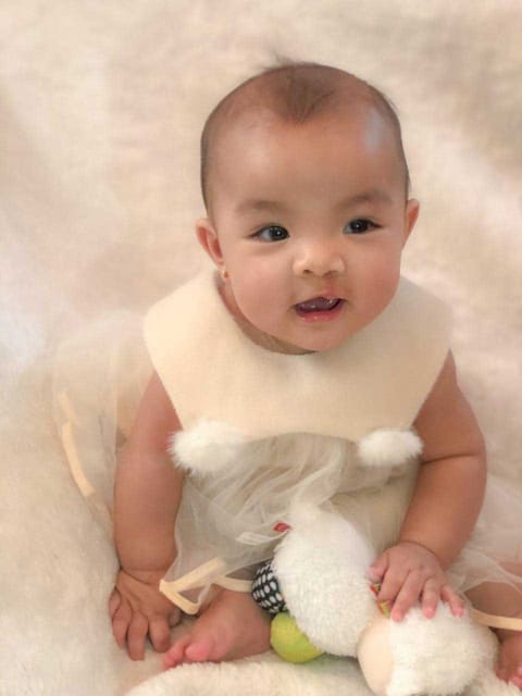 Antheia after the surgery to rectify her cleft lip -- an opening in the upper lip.
