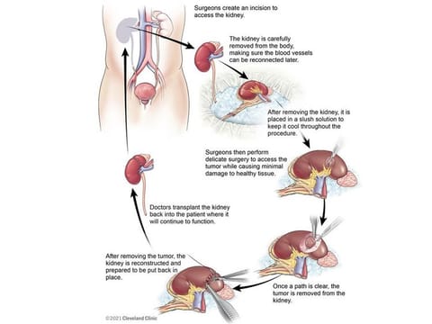After accessing the tumour and removing it under strong magnification, the surgeons repaired Shamsi’s kidney and began the delicate work of transplanting it back into his body.