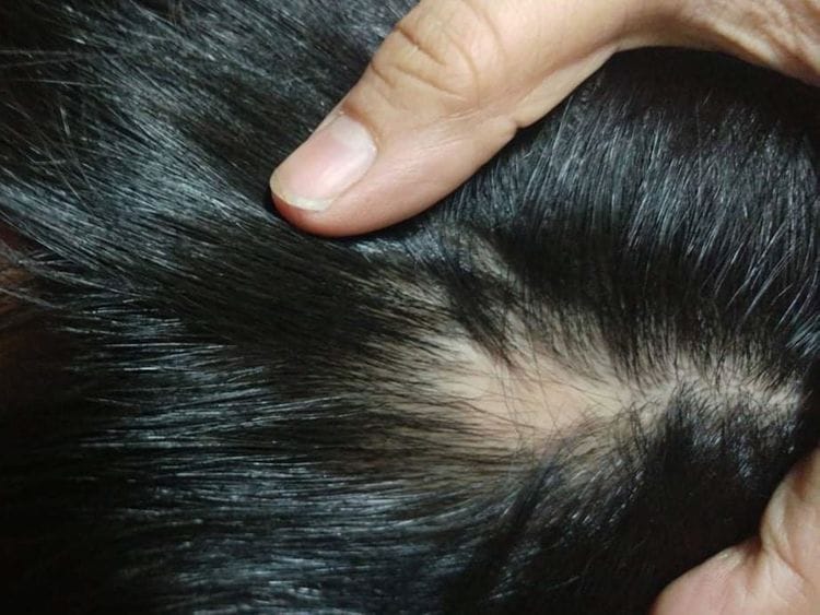 Sarah Gul's five year old was diagnosed with alopecia 