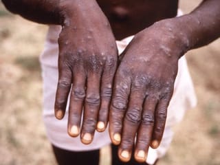 Monkeypox found in US and UK. What is it and should you be worried?