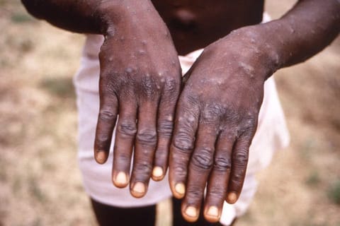 An image created during an investigation into an outbreak of monkeypox, which took place in the Democratic Republic of the Congo (DRC), 1996 to 1997, shows the hands of a patient with a rash due to monkeypox, in this undated image obtained by Reuters on May 18, 2022. 