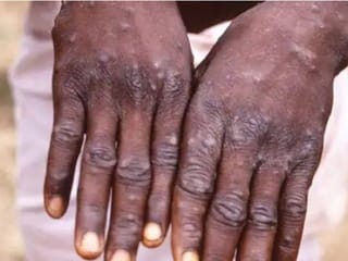 Vaccines against mpox virus? What we know so far