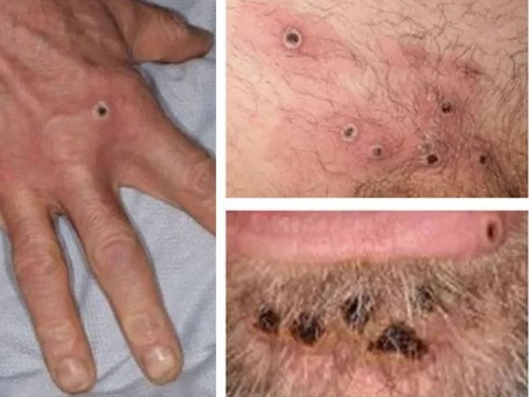 monkeypox rash lessions collage of monkeypox rash lesions at an undisclosed date and location. 
