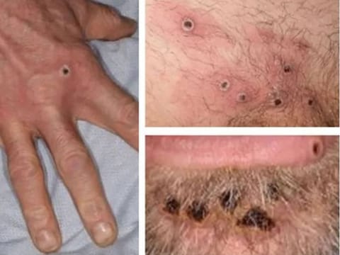 A handout photo taken on Wednesday, June 22, 2022, made available by the UK Health Security Agency shows a collage of monkeypox rash lesions at an undisclosed date and location. 