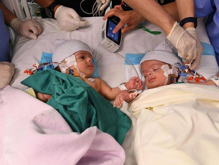 The Yemeni twins Salman and Abdullah.  Below: A link to a video aired by Saudi TV Al Ekhbariya shows the twins' father trying to kiss the head of Dr Al Rabeeah in a sign of appreciation following the successful separation procedure.