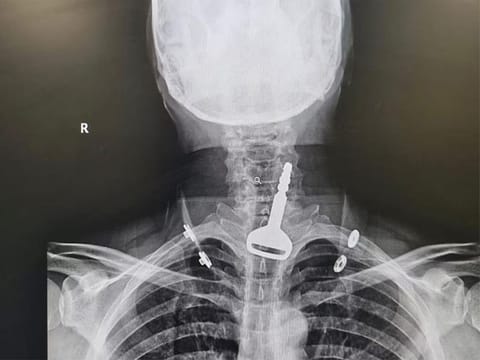 The key stuck in the  respiratory tract.