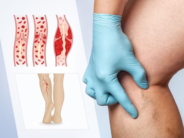 DVT