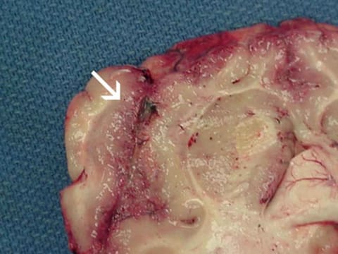 Focal hemorrhage and necrosis in frontal cortex due to Naegleria fowleri.