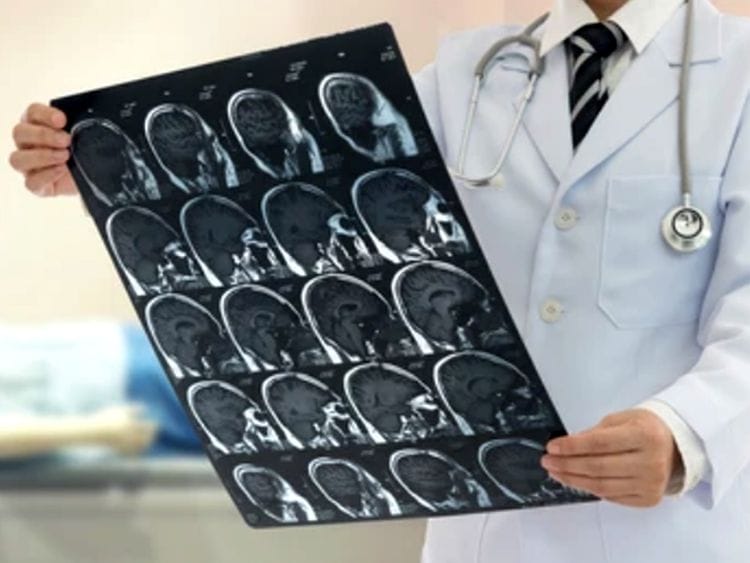 Prevent stroke naturally with these simple tips