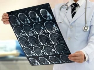 Prevent stroke naturally with these simple tips