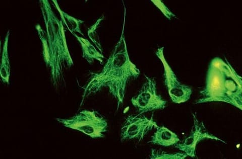 Fluorescent stained ovarian carcinoma cells.  